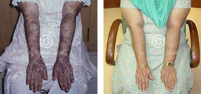 Lichen Planus Before and After Case Photo