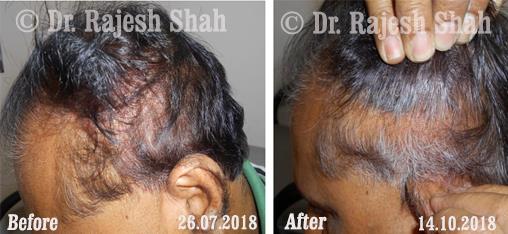 Psoriasis Before and After Case Photo