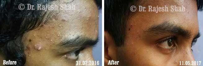 Acne Before and After Case Photo