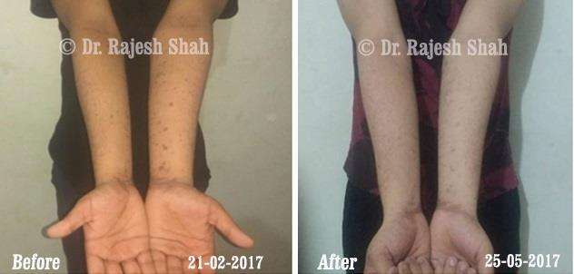 Lichen Planus Before and After Case Photo