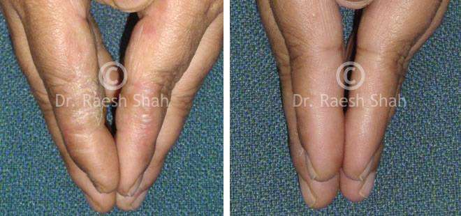 Eczema Before and After Case Photo