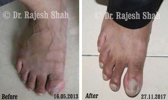 Vitiligo Before and After Case Photo