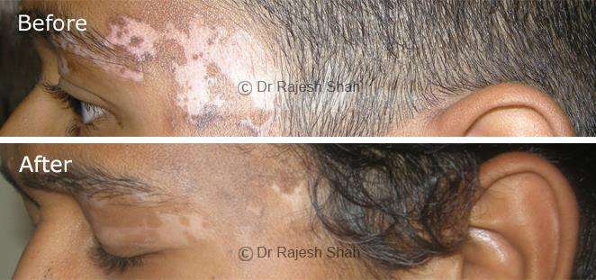Vitiligo Before and After Case Photo
