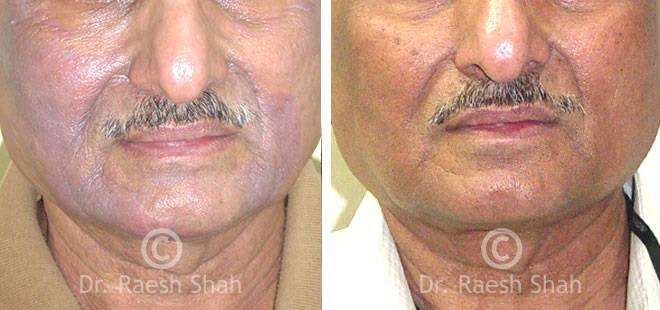 Eczema Before and After Case Photo