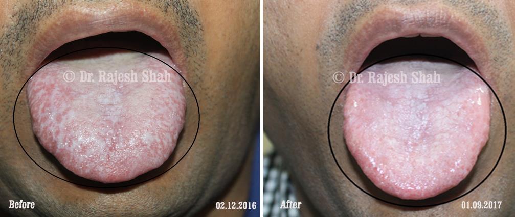 Lichen Planus Before and After Case Photo