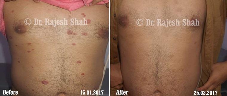 Psoriasis Before and After Case Photo