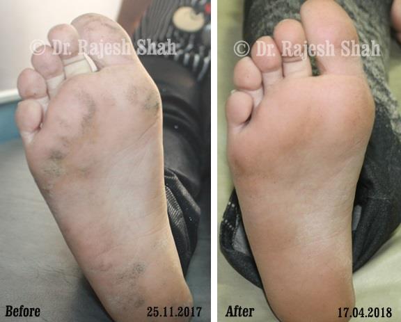 Psoriasis Before and After Case Photo