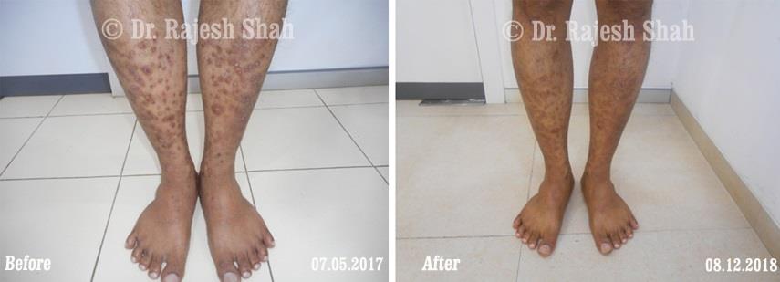 Lichen Planus Before and After Case Photo