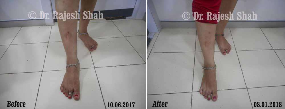 Psoriasis Before and After Case Photo