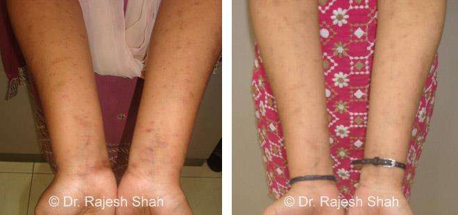 Lichen Planus Before and After Case Photo
