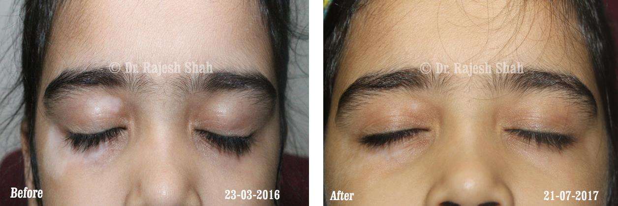 Vitiligo Before and After Case Photo