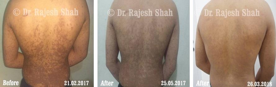 Lichen Planus Before and After Case Photo