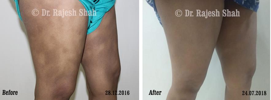 Lichen Planus Pigmentosa Before and After Case Photo