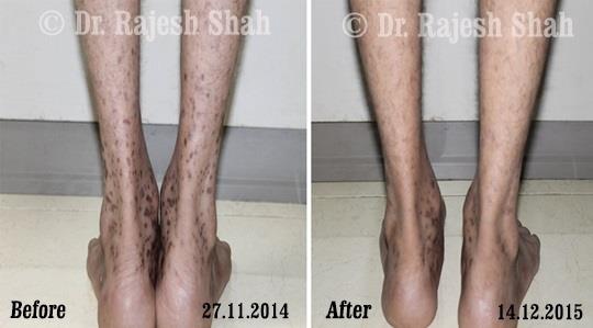 Lichen Planus Before and After Case Photo