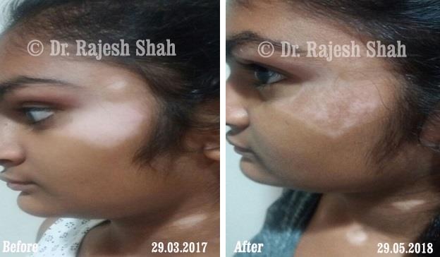 Vitiligo Before and After Case Photo