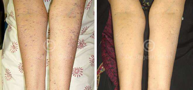 Lichen Planus Before and After Case Photo