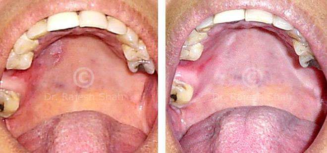 Lichen Planus Before and After Case Photo