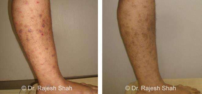 Lichen Planus Before and After Case Photo