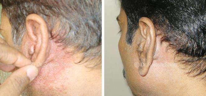 Psoriasis Before and After Case Photo