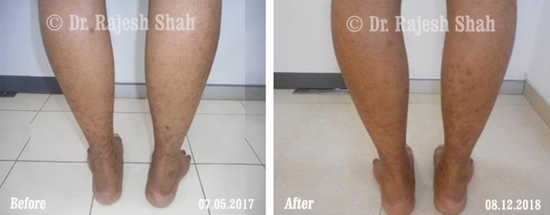 Lichen Planus Before and After Case Photo