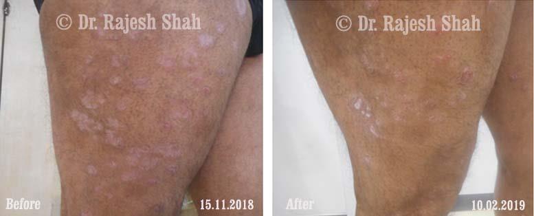 Psoriasis Before and After Case Photo
