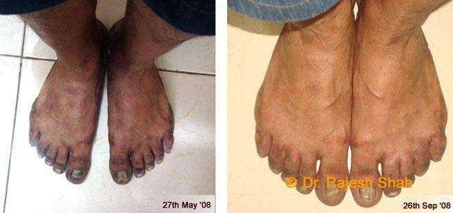 Psoriasis Before and After Case Photo