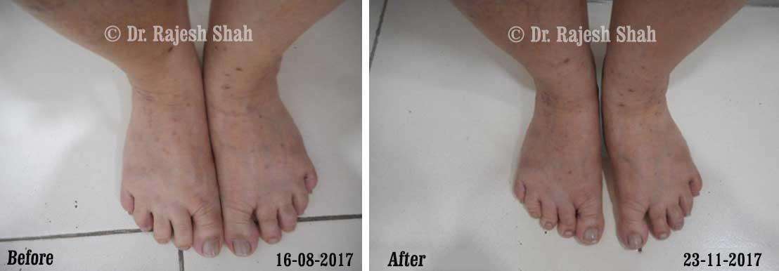 Lichen Planus Before and After Case Photo