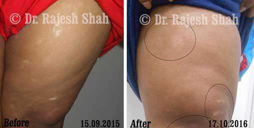 Vitiligo Before and After Case Photo