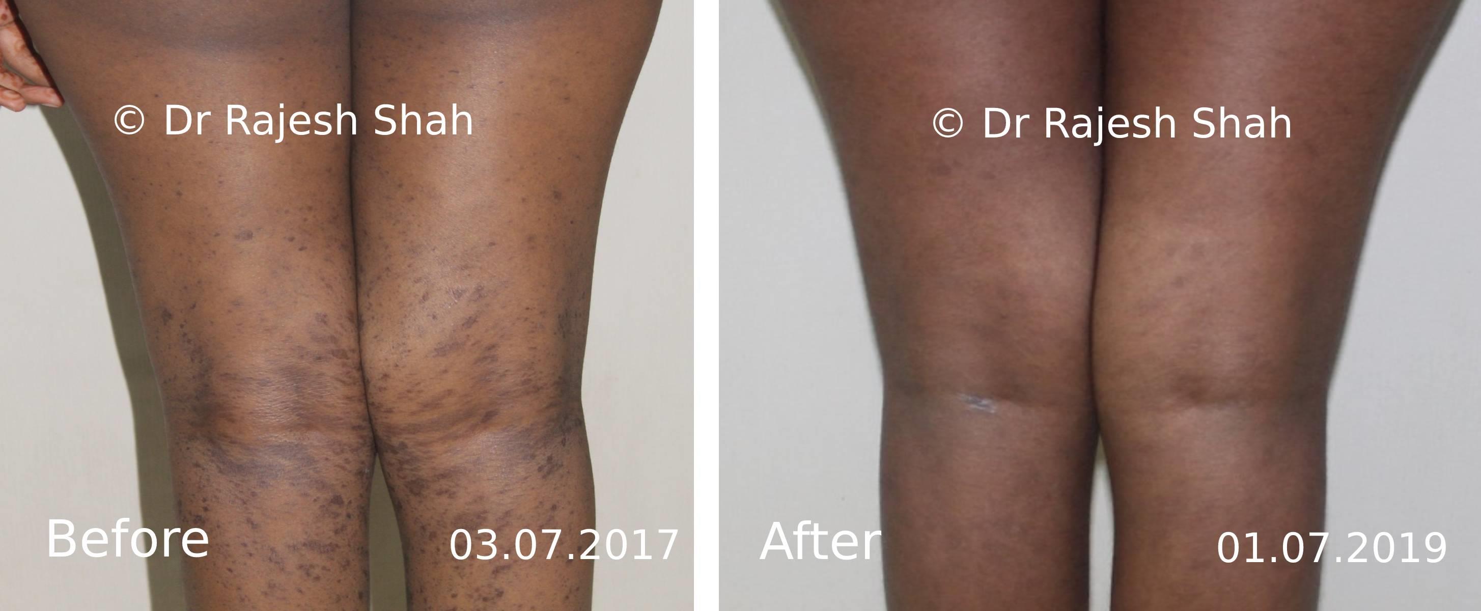 Lichen Planus Before and After Case Photo