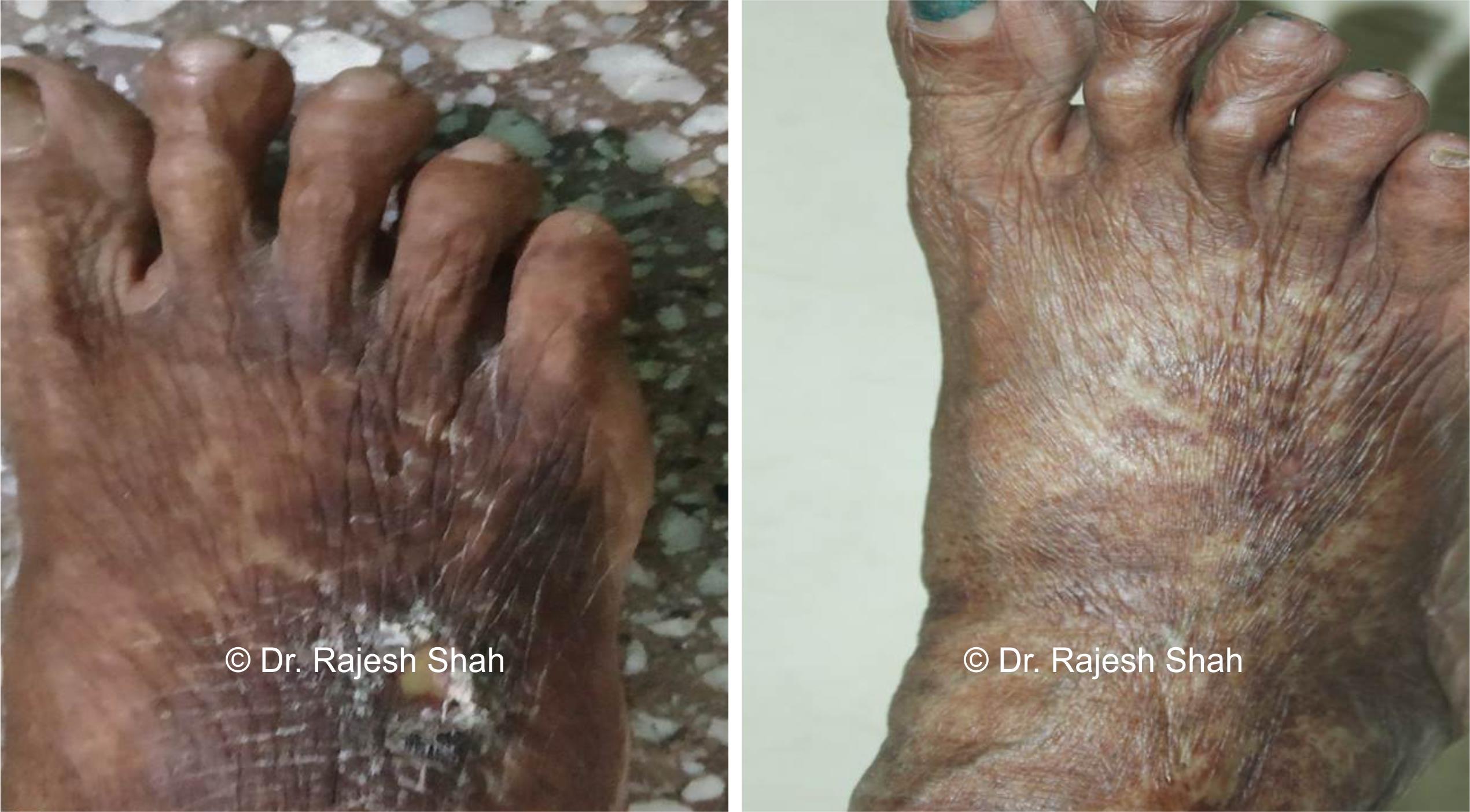 Non-healing ulcers Before and After Case Photo