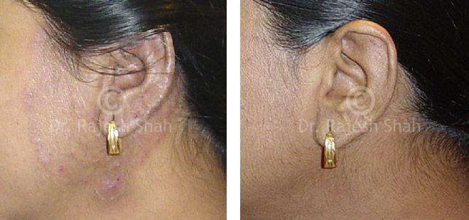 Psoriasis Before and After Case Photo