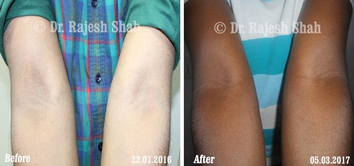 Psoriasis Before and After Case Photo