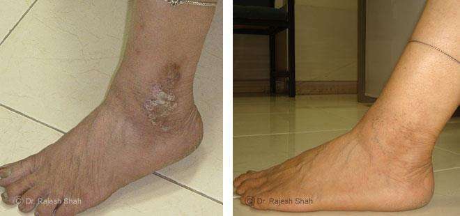 Eczema Before and After Case Photo