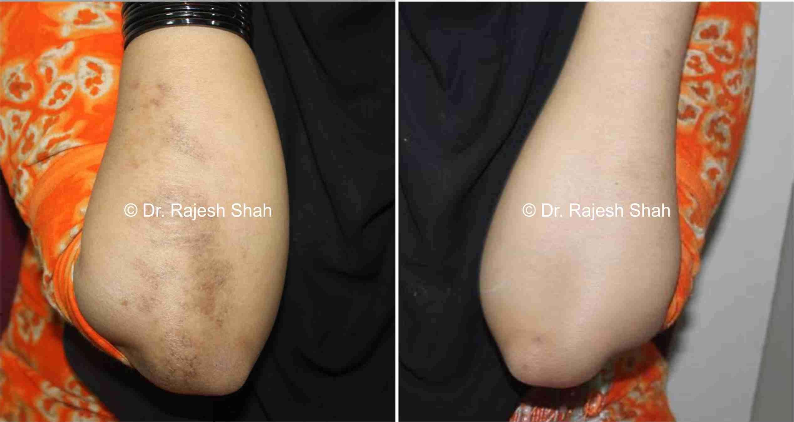 Lichen Planus Before and After Case Photo