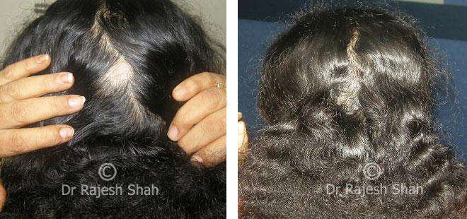 Alopecia Areata Before and After Case Photo