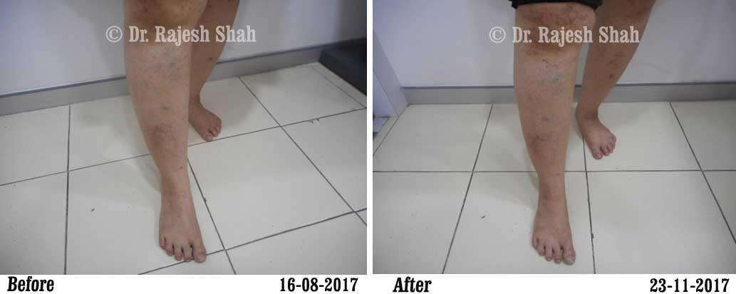 Lichen Planus Before and After Case Photo