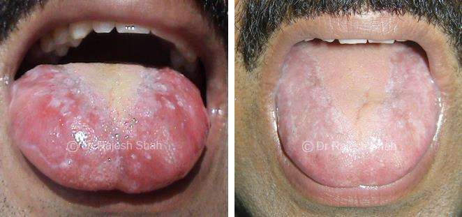 Lichen Planus Before and After Case Photo