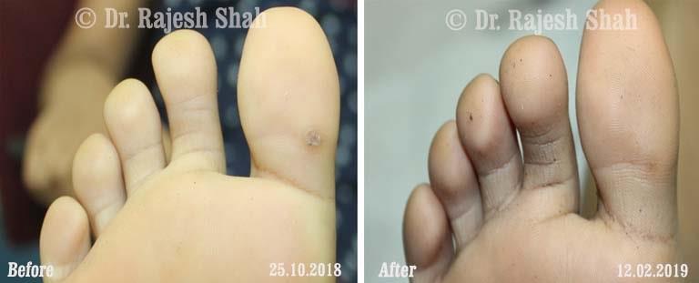 Warts Before and After Case Photo