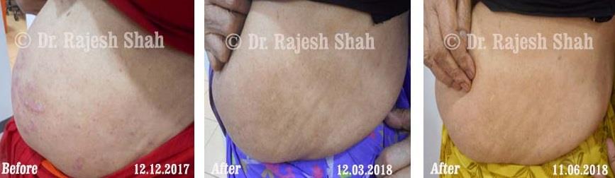 Psoriasis Before and After Case Photo