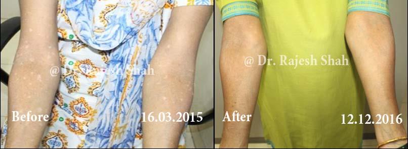 Vitiligo Before and After Case Photo