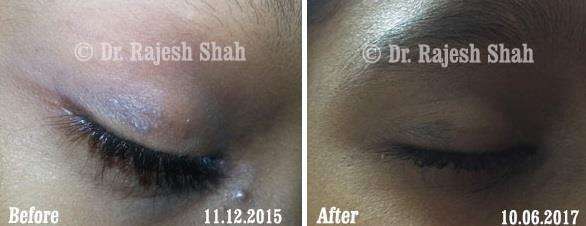 Lichen Planus Before and After Case Photo