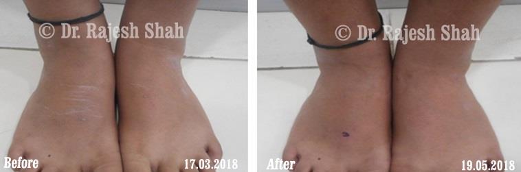 Alopecia Areata Before and After Case Photo