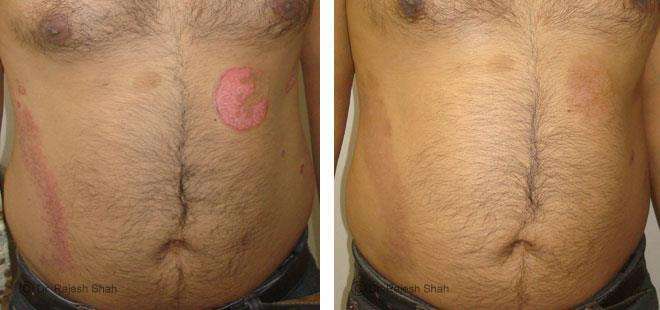 Psoriasis Before and After Case Photo