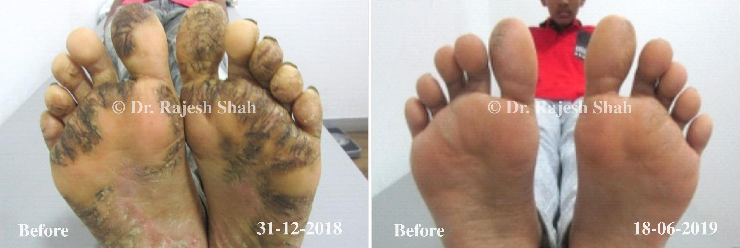Eczema Before and After Case Photo