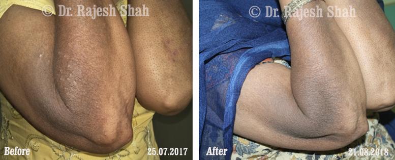 Atopic Dermatitis Before and After Case Photo