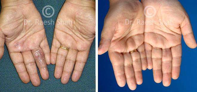 Eczema Before and After Case Photo