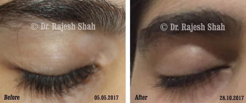 Vitiligo Before and After Case Photo