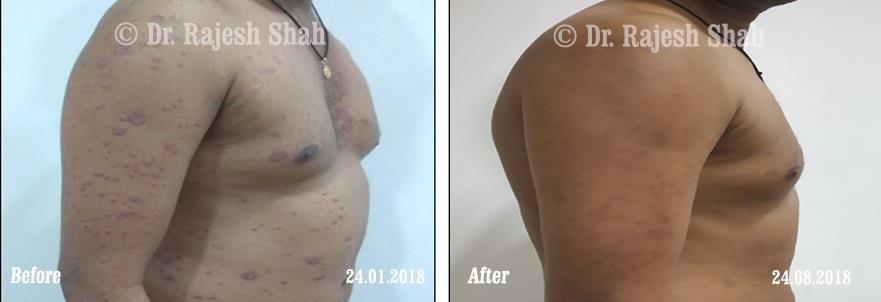 Psoriasis Before and After Case Photo