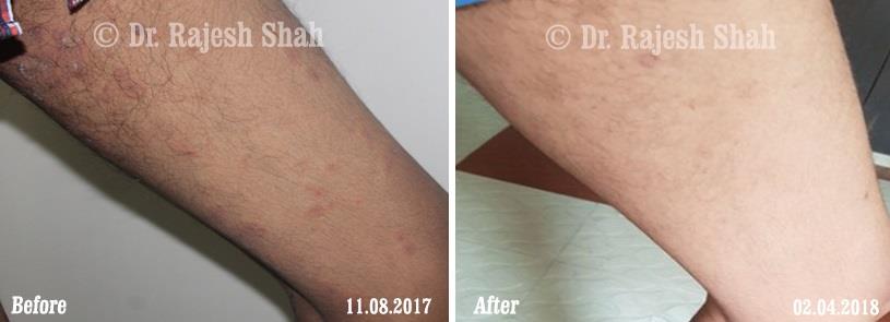 Lichen Planus Before and After Case Photo