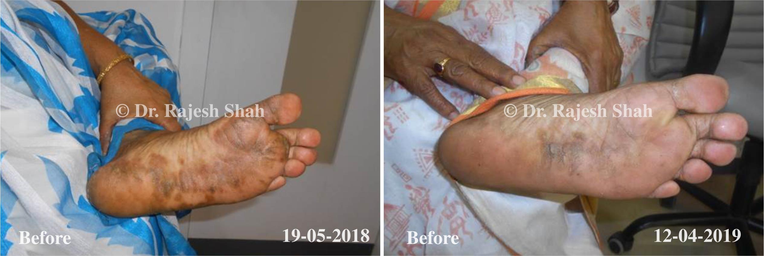 Psoriasis Before and After Case Photo